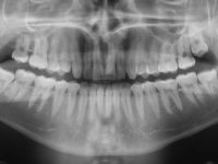Panoramic Dental X-Ray