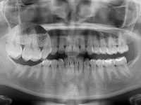 Panoramic-x-ray